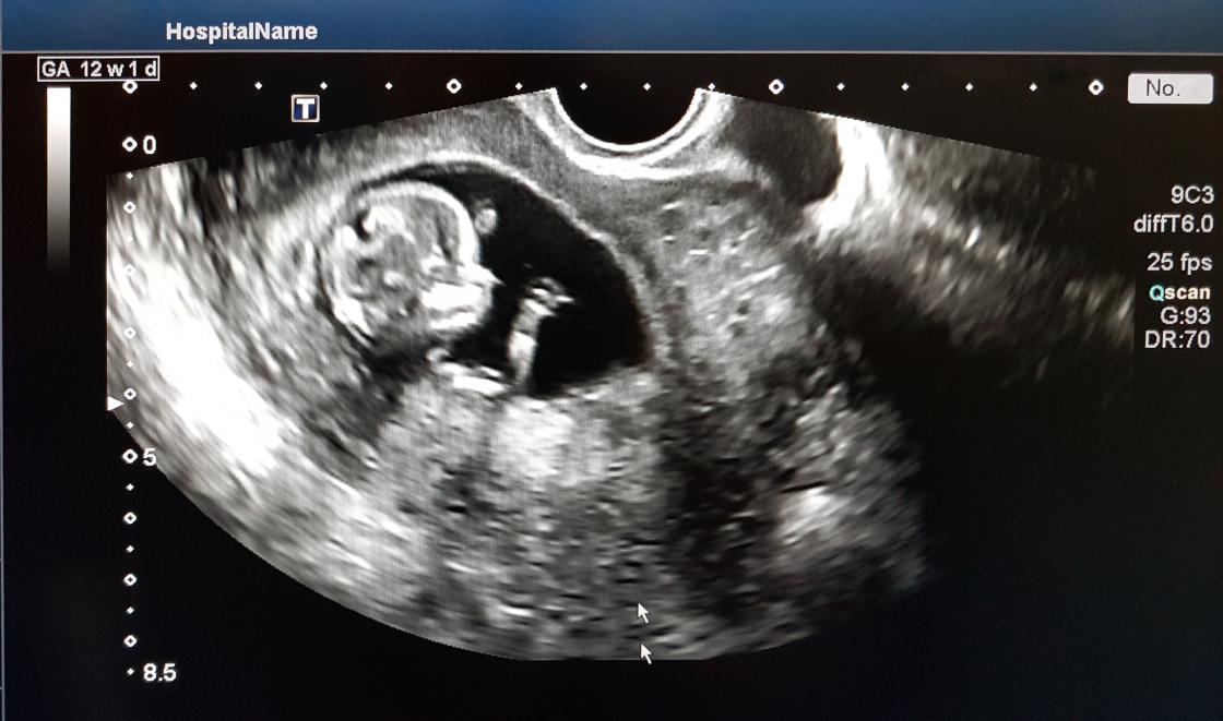 Baby scan